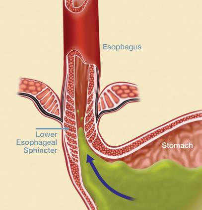 gerd symptoms