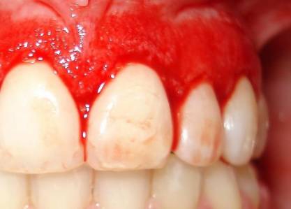 How to Relieve Sore Gums and Teeth | IYTmed.com