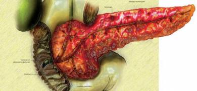 Acute Pancreatitis