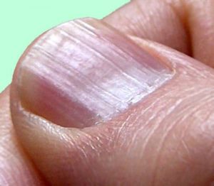 Ridges in Fingernails - IYTmed.com