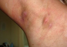 Lump under Armpit