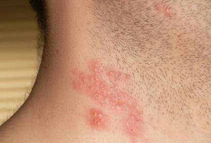 Shingles without Rash