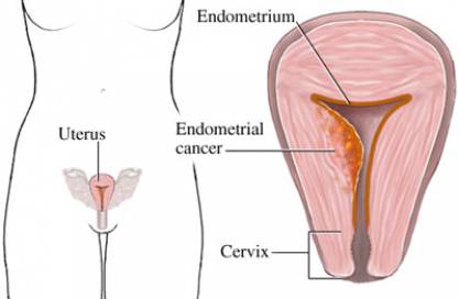 How is uterine thickening treated?