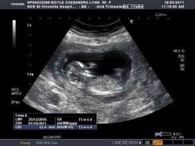 weeks pregnant ultrasound pregnancy week scan baby fetus expect iytmed human