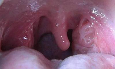 Swollen Tonsil on One Side