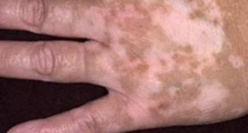 A variety of health conditions and factors can cause white spots to develop on different parts of the body.