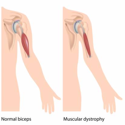 Muscular Dystrophy in Adults