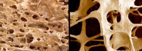 osteoporosis causes