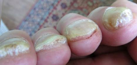 Soften hard toenails