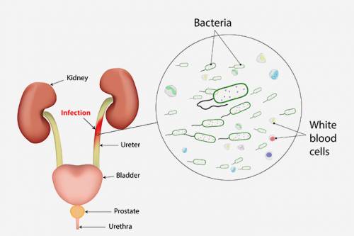 urinary infection during pregnancy