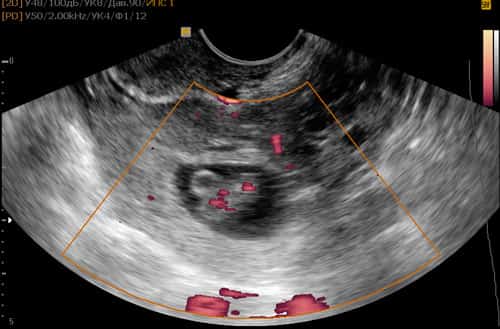 Ectopic pregnancy occurs in 1%-2% of all pregnancies.