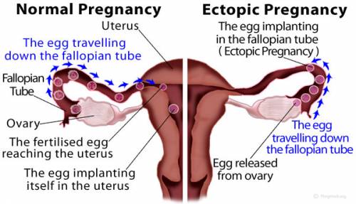 Ectopic Pregnancy