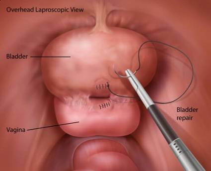 Bladder Fistula