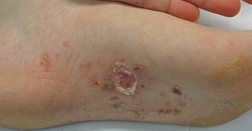 What Causes Little Red Blisters On Feet