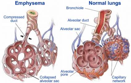 Chronic obstructive pulmonary disease