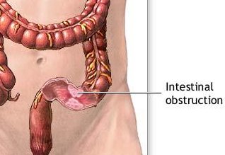 Image result for intestinal obstruction