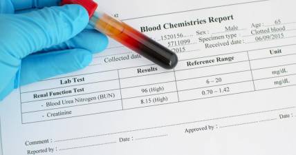 Creatinine Blood Test - it is an important marker of how well the kidneys are working.