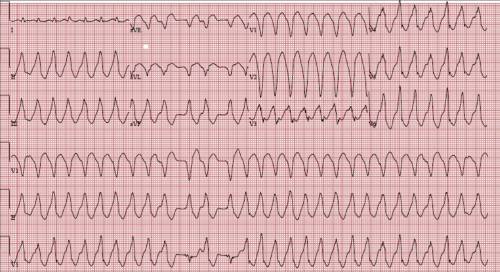 what is ventricular tachycardia