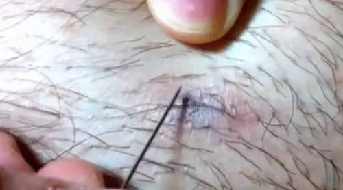 Ingrown Hair Cyst: Causes, Symptoms and Best Removal Methods