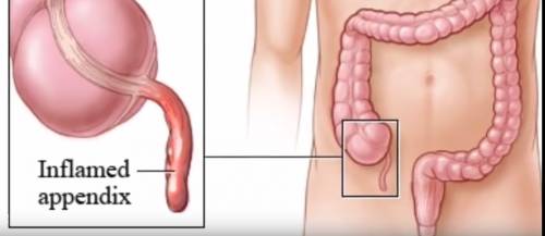 what side is appendix on the body