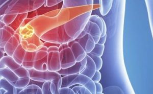 Pancreatic Cancer: Causes, Symptoms, Stages and Treatment | IYTmed.com