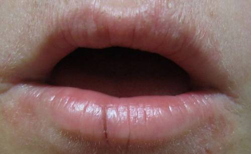 discoloration in your lip