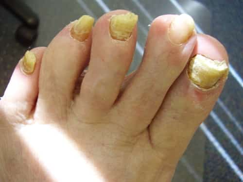 Softening toenails