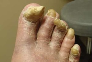 93_hard-thick-toenails | Health Recovery Tips