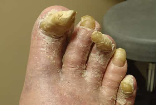 Hard thick toenails