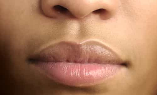 Upper lip color change