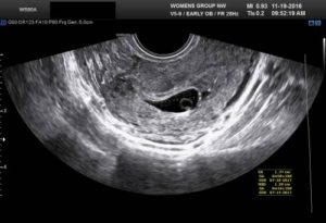 ultrasound pictures of 4 week old fetus