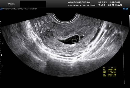 ultrasound image shows a gestational sac