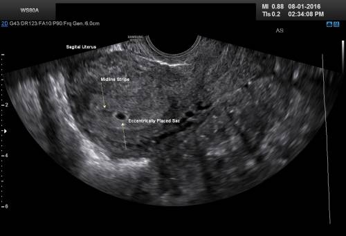 4 Weeks Pregnant Ultrasound: Pictures and Description ...