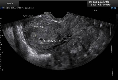 gestational sac of about 3-6mm