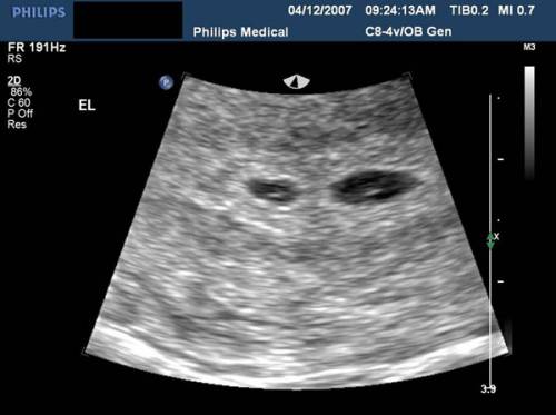 ultrasound report at 4 weeks