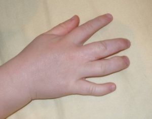 What Causes Swollen Hands in the Morning? | IYTmed.com