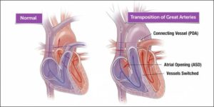 Transposition of the Great Vessels: Causes, Signs, Treatment and Facts