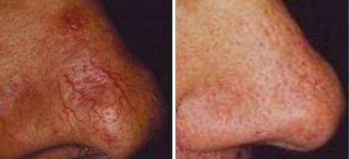 How To Get Rid Of Tiny Spider Veins On Face