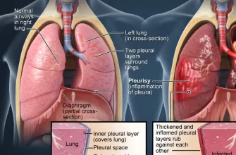 Medical illustration comparing normal lung anatomy (Panel A) with a lung affected by pleurisy (Panel B). Arrows show inflammation and thickening of the pleura causing friction, with detailed cross-section inserts comparing a normal pleural space and lung to an inflamed pleurisy state and an infected lung.