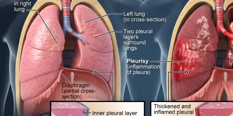 Medical illustration comparing normal lung anatomy (Panel A) with a lung affected by pleurisy (Panel B). Arrows show inflammation and thickening of the pleura causing friction, with detailed cross-section inserts comparing a normal pleural space and lung to an inflamed pleurisy state and an infected lung.
