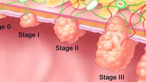 stage 4 colon cancer survival rate