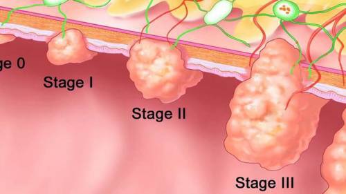 Stage 3b Colon Cancer Survival Rate By Age