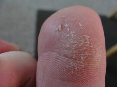 What does it mean when your toes are peeling?