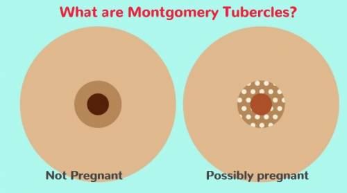 Montgomery's tubercles are typically normal and indicate your breasts are operating as they should. The tubercles will usually shrink or vanish totally by themselves following pregnancy and breastfeeding. On image: montgomery tubercles in pregnant woman