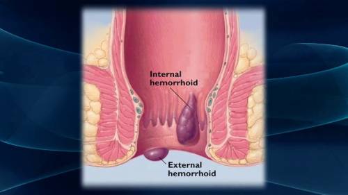 Picture of Hemorrhoids in Adult