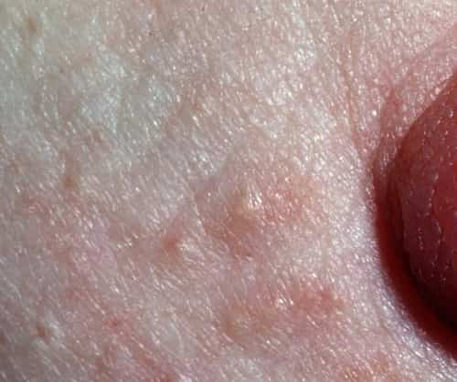 When Do Montgomery Tubercles Appear In Pregnancy Iytmed Com