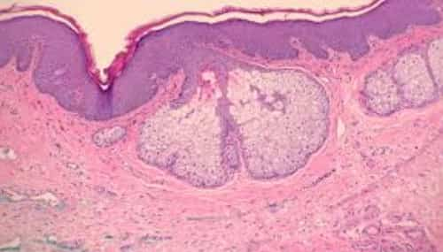 Montgomery Tubercles Appear During Pregnancy