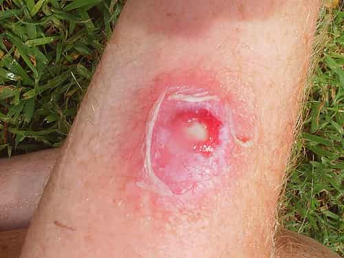 MRSA on leg