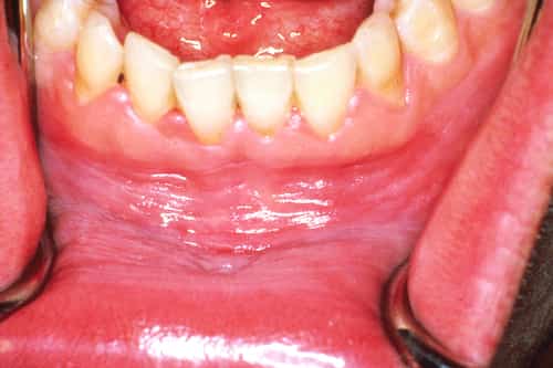 White Gums Around Teeth