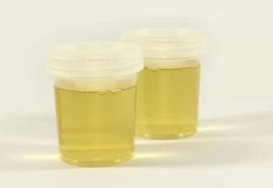 Squamous Epithelial Cells in Urine - IYTmed.com